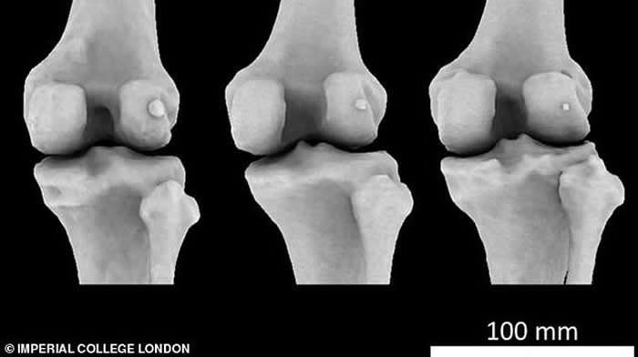 图中显示3个不同膝骨样本存在不同大小的豆骨。科学家发现1918年全球11.2%居民体内存在豆骨，但截至2018年，全球39%居民体内存在豆骨。