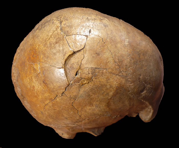 表现出大的凹陷性骨折的Cioclovina颅骨右侧视图