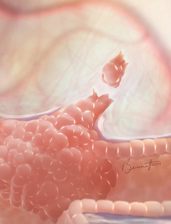 《Nature》：乳腺癌细胞在癌症转移过程中以相互粘附的方式在体内扩散