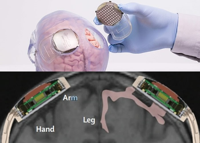 感应器安装在颅骨及大脑之间。