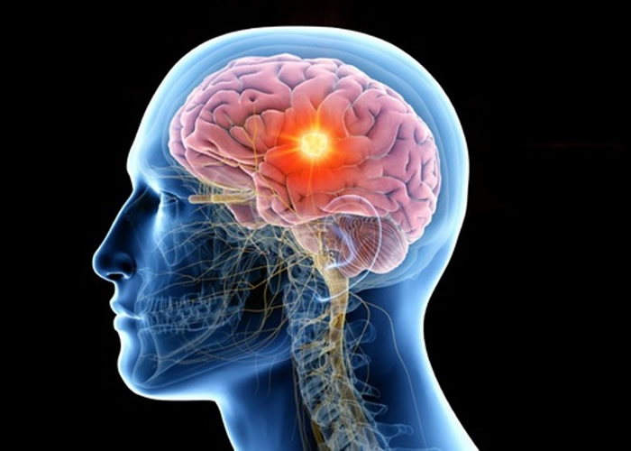 RGS4的大脑蛋白质或是破坏慢性疼痛症状的关键。