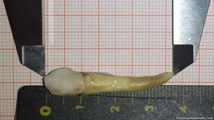 德国奥芬巴赫市牙医为患者拔下一颗创吉尼斯世界纪录的3.7厘米长牙齿
