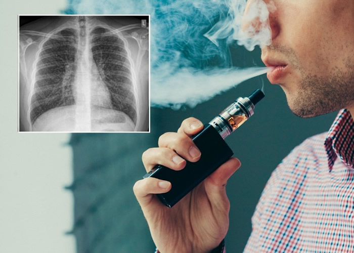 加拿大17岁少年吸食有味电子烟5个多月后出现严重闭塞性细支气管炎症状