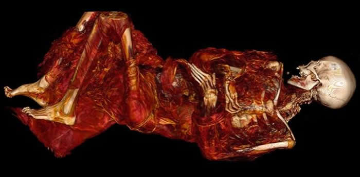 500年木乃伊研究发现格陵兰岛因纽特人以富含Omega-3脂肪酸的鱼类为主食 依旧有动脉硬化问题