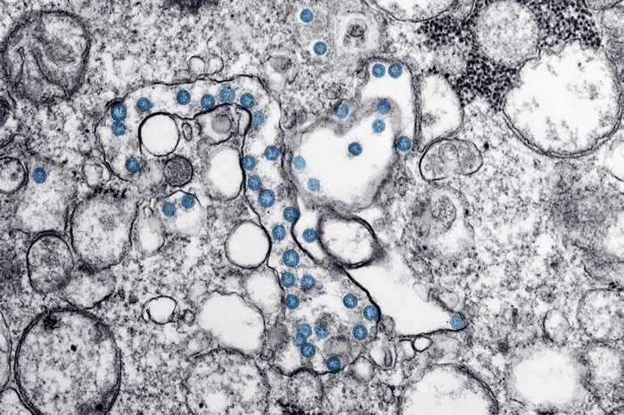 从美国第一位感染COVID-19的病人体内分离出来的新型冠状病毒，利用穿透式电子显微镜观察到的影像，可看到球形的病毒颗粒（蓝色）的病毒基因组（黑色小点）。IMA