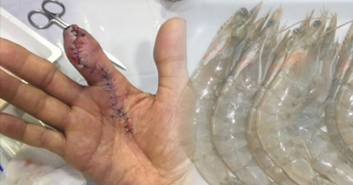 处理海鲜要做好防护措施！新加坡男子洗虾被刺伤 染上致命“食肉菌”手指遭截肢