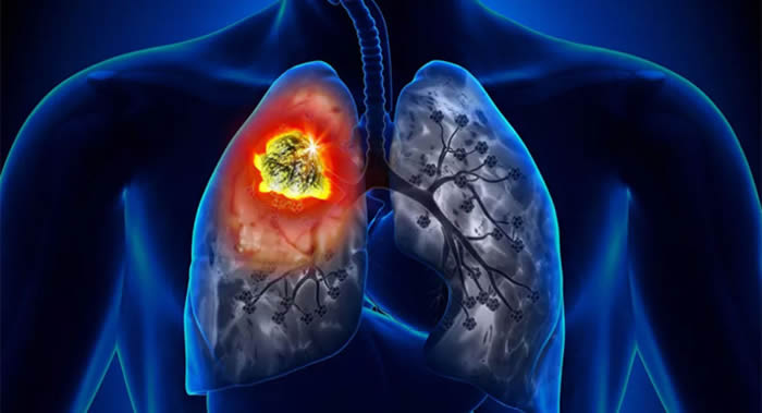 肺癌的最初症状常常与呼吸系统无关 常被误认为是肺炎或慢性支气管炎