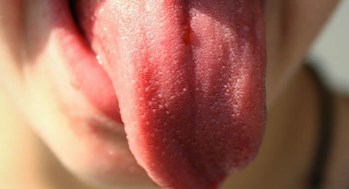 口腔颌面外科肿瘤医生：患者不认真对待假牙可能会导致舌癌