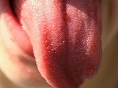 舌头光滑、胖大、发红可能是缺乏维生素B12的表现 会增加恶性贫血风险