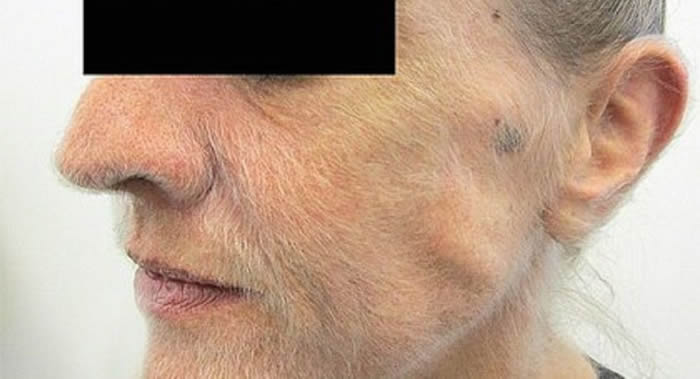 澳大利亚维克多利亚州墨尔本市一名女性吸烟者因肺癌脸上长满了毛发