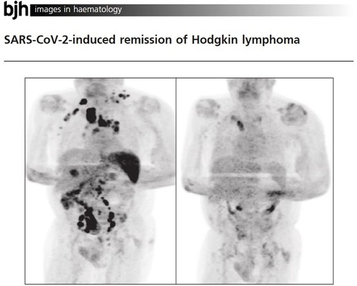 一名病患在感染新冠肺炎后体内癌细胞大量消失，右图为染疫后的造影。（图／翻摄自British Journal of Haematology）