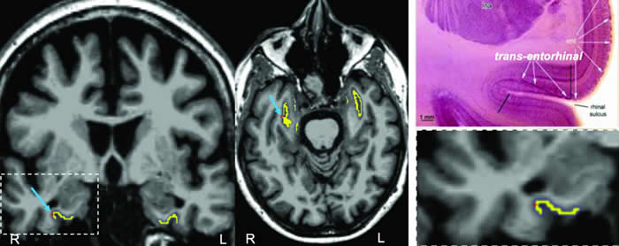 自动成像揭示阿尔茨海默氏病的脑中TAU蛋白起源