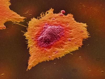 研究发现新药adavosertib能减缓肠癌肿瘤生长速度