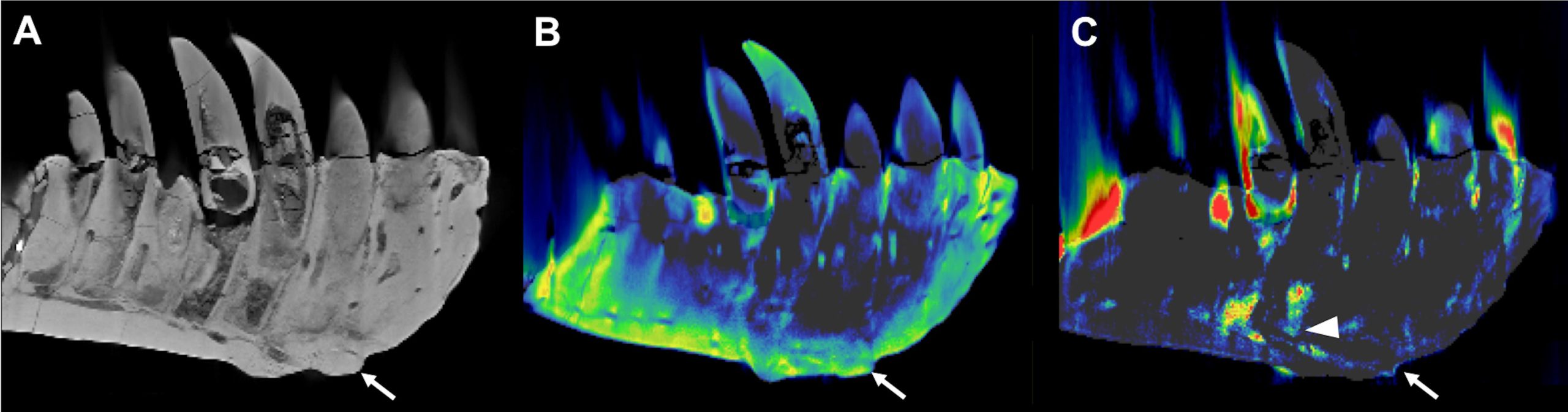 左侧牙床的含牙部分的CT重建。(A）常规CT图像的重建，在侧视图中显示了保存良好的解剖结构，如替换的牙齿。箭头所指的是第3-5个牙根水平的腹侧表面的病灶外植体-