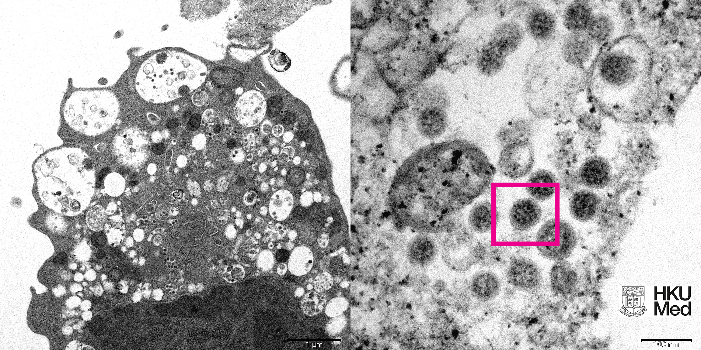 香港大学医学院发布电子显微镜下新冠病毒奥密克戎Omicron变体的真实面貌