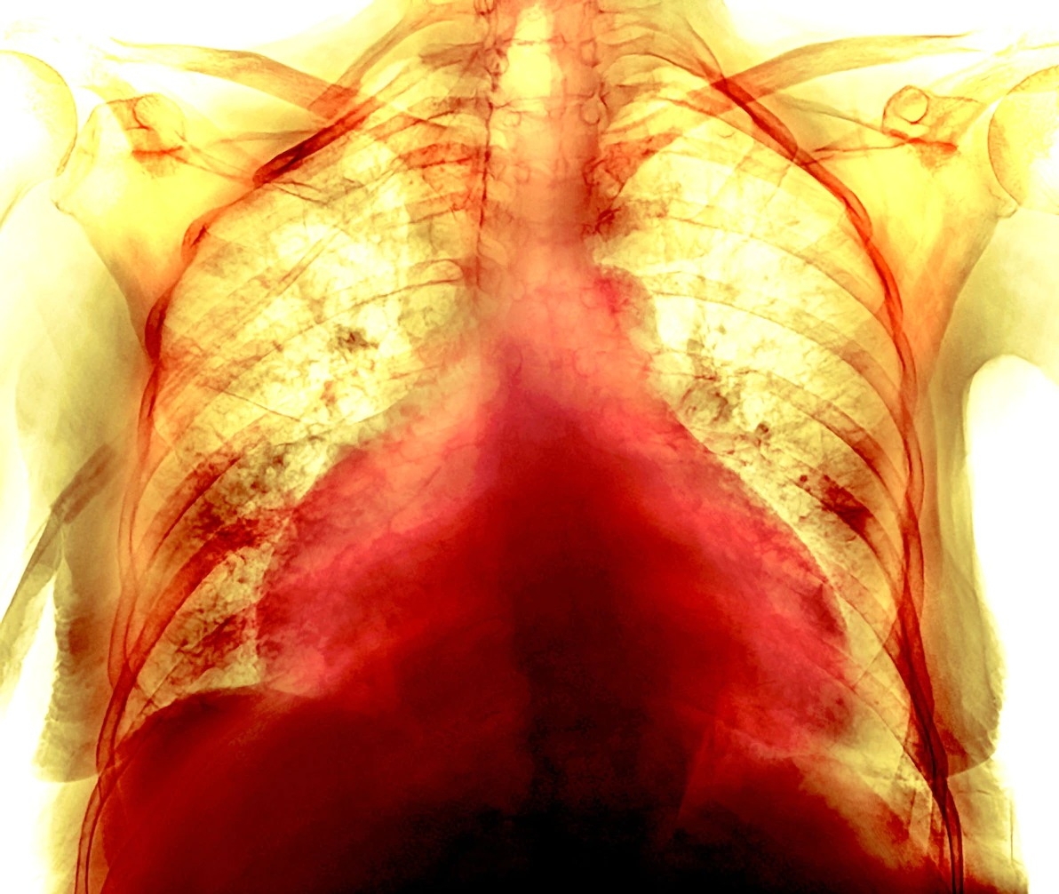 这张彩色胸腔X光影像显示一名74岁女性COVID-19病患的肥大心脏。有些病患从COVID-19康复的几个月后持续出现心血管症状──即使他们的胸腔扫描及其他检查