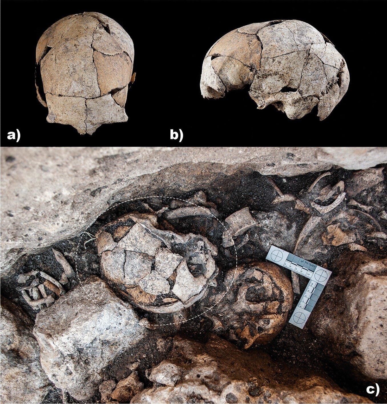 西班牙埃尔潘多尼斯巨石阵发现的人类头骨研究显示最早的耳科手术发生在5300年前